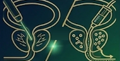 Laser Surgery vs Prostate Artery Embolization (PAE)